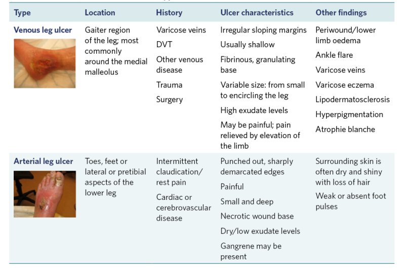 Table showing characteristics of the main types of chronic lower-limb wounds. 