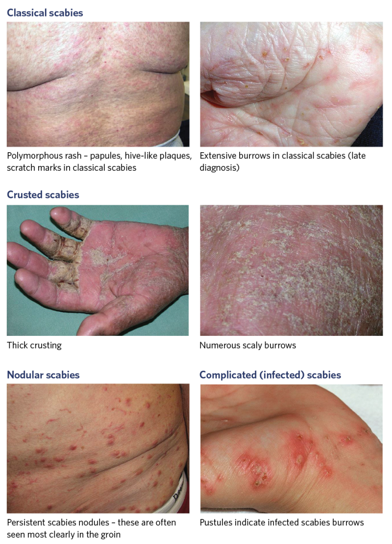 Photos to support diagnosis of scabies. 