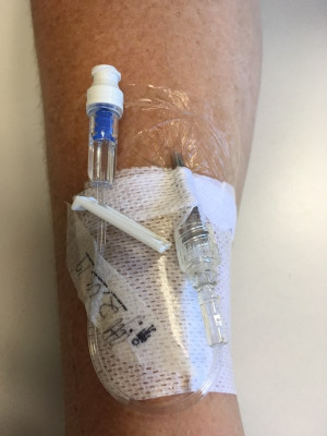 An image of a peripheral intravenous catheter